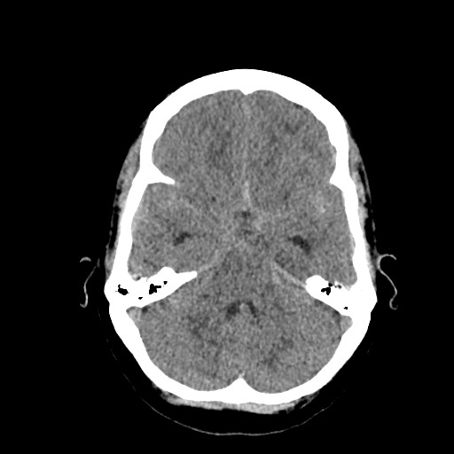 Acute subarachnoid hemorrhage and accessory anterior cerebral artery (Radiopaedia 69231-79008 Axial non-contrast 17).jpg