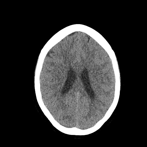 Acute subarachnoid hemorrhage and accessory anterior cerebral artery (Radiopaedia 69231-79008 Axial non-contrast 34).jpg