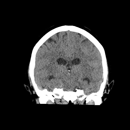 Acute subarachnoid hemorrhage and accessory anterior cerebral artery (Radiopaedia 69231-79008 Coronal non-contrast 41).jpg