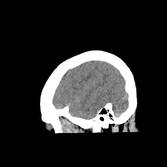 Acute subarachnoid hemorrhage and accessory anterior cerebral artery (Radiopaedia 69231-79008 Sagittal non-contrast 48).jpg