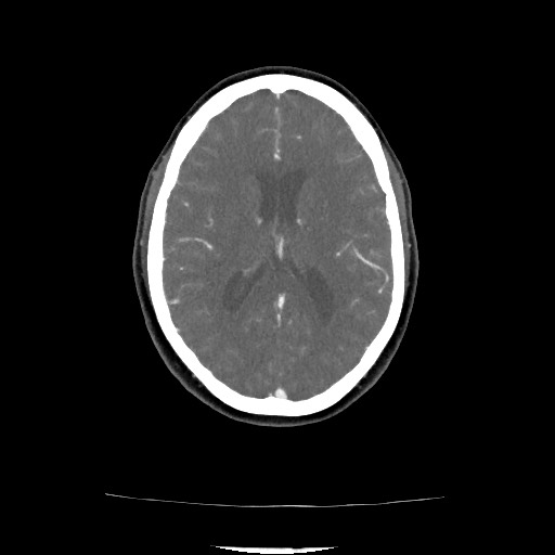 File:Acute subarachnoid hemorrhage and accessory anterior cerebral artery (Radiopaedia 69231-79009 Axial C+ arterial phase 102).jpg