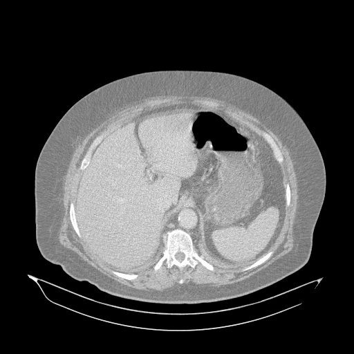 File:Acute superior mesenteric artery occlusion (Radiopaedia 51288-56960 Axial lung window 2).jpg