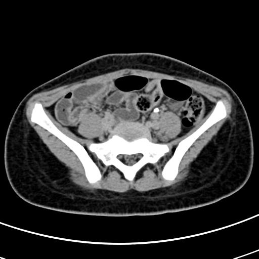 File:Acute suppurative pyelonephritis (Radiopaedia 18306-18147 Axial renal excretory phase 118).jpg