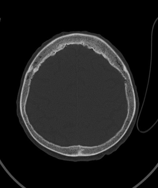 Acute traumatic subdural hematoma (Radiopaedia 82921-97257 Axial bone window 31).jpg
