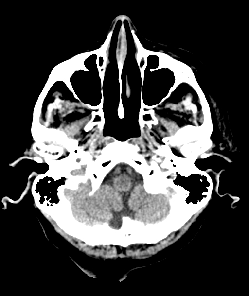 Acute traumatic subdural hematoma (Radiopaedia 82921-97257 Axial non-contrast 55).jpg
