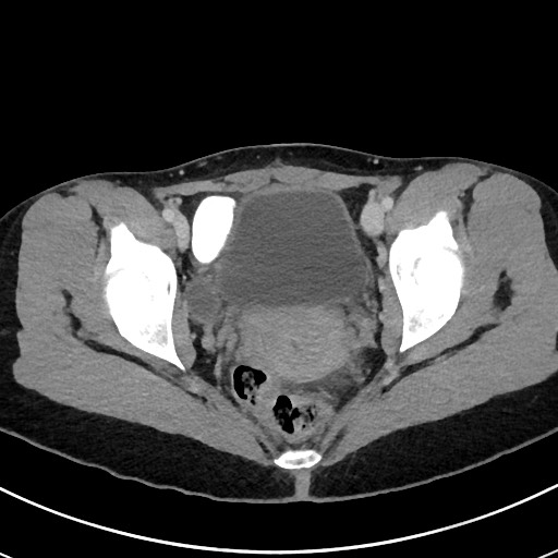 File:Acute uncomplicated appendicitis (Radiopaedia 61374-69304 Axial 84).jpg