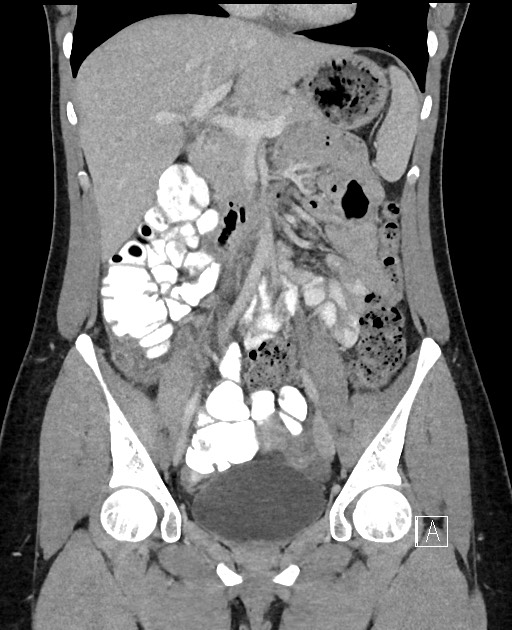 Acute uncomplicated appendicitis (Radiopaedia 61374-69304 Coronal C+ portal venous phase 44).jpg