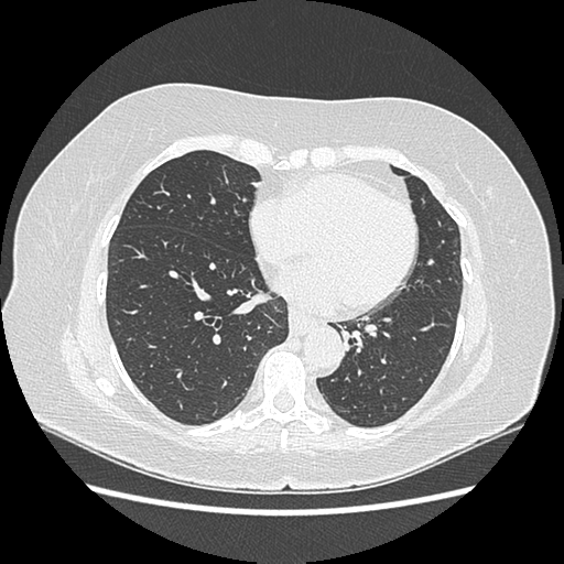 Adenocarcinoma in situ of lung (Radiopaedia 38685-40829 B 143).png