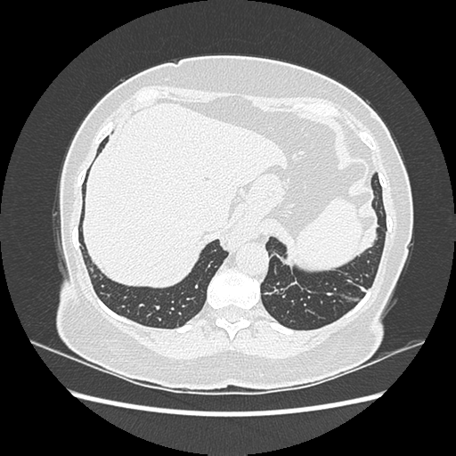 Adenocarcinoma in situ of lung (Radiopaedia 38685-40829 B 192).png