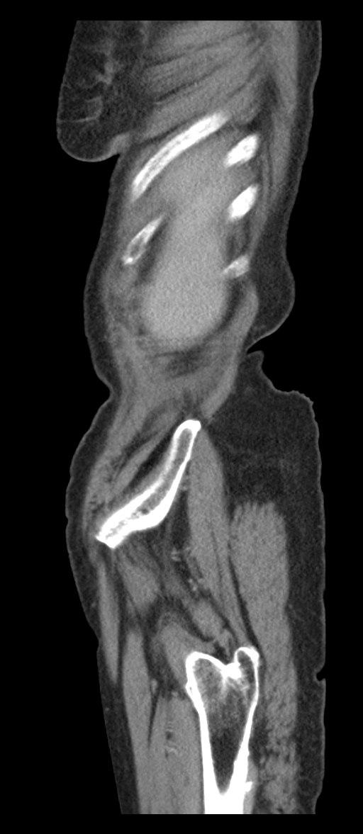 Adenocarcinoma of cecum (Radiopaedia 59222-66549 Sagittal C+ portal venous phase 92).jpg