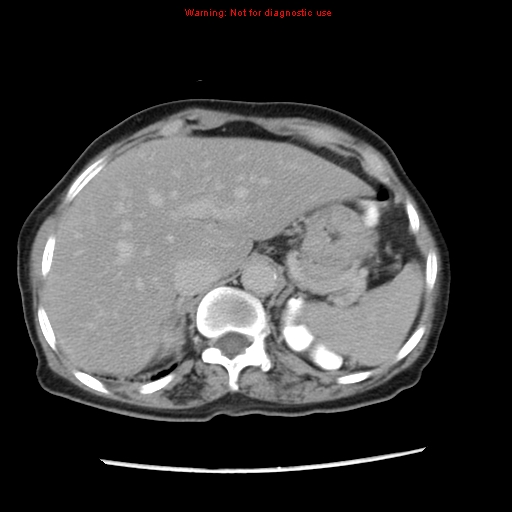 File:Adenocarcinoma of the colon (Radiopaedia 8191-9039 Axial renal excretory phase 3).jpg