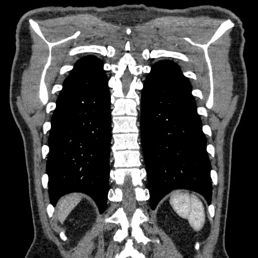 Adenocarcinoma of the lung (Radiopaedia 59871-67325 Coronal C+ arterial phase 60).jpg