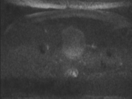 Adenocarcioma of rectum- T1 lesion (Radiopaedia 36921-38546 Axial DWI 76).png