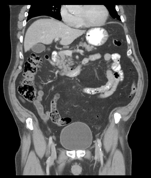 Adenocarcioma of rectum- T1 lesion (Radiopaedia 36921-38547 Coronal C+ portal venous phase 27).png