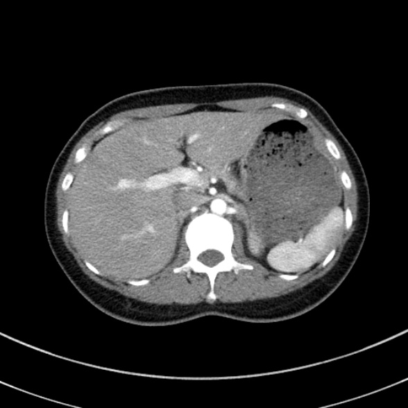 File:Adenocystic carcinoma of the trachea (Radiopaedia 47677-52525 Axial C+ arterial phase 79).jpg