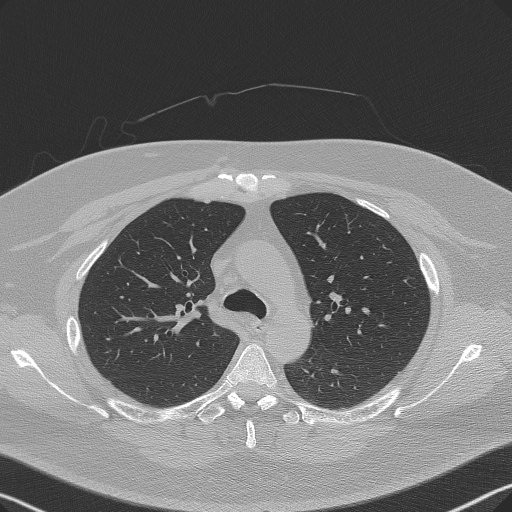 File:Adenoid cystic carcinoma of the trachea (Radiopaedia 49042-54137 Axial lung window 108).jpg