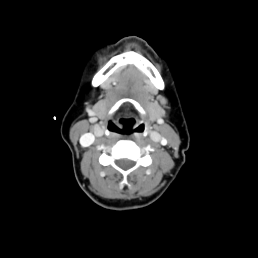 File:Adenoid cystic tumor of palate (Radiopaedia 46980-51518 Axial C+ delayed 44).png