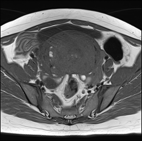 File:Adenomyosis - ovarian endometriomas (Radiopaedia 67031-76350 Axial T1 11).jpg