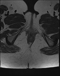 File:Adnexal multilocular cyst (O-RADS US 3- O-RADS MRI 3) (Radiopaedia 87426-103754 Axial T2 29).jpg