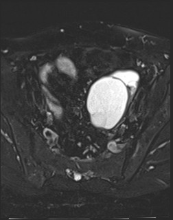 File:Adnexal multilocular cyst (O-RADS US 3- O-RADS MRI 3) (Radiopaedia 87426-103754 Axial T2 fat sat 9).jpg