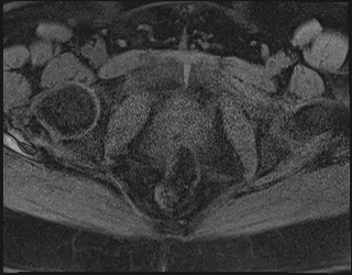 File:Adnexal multilocular cyst (O-RADS US 3. O-RADS MRI 3) (Radiopaedia 87426-103754 Axial 206).jpeg