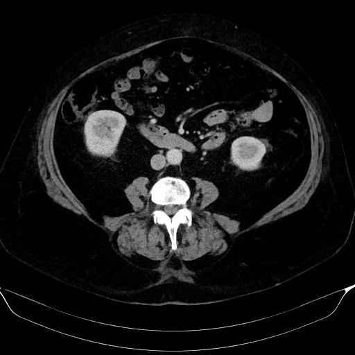 Adrenal cortical carcinoma (Radiopaedia 64017-72769 Axial C+ portal venous phase 38).jpg