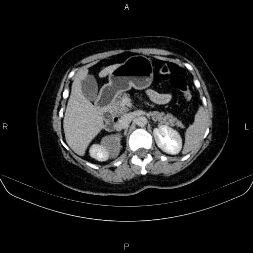 Adrenal cortical carcinoma (Radiopaedia 84882-100379 Axial C+ delayed 28).jpg
