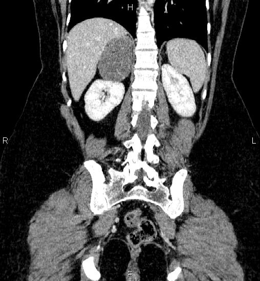 Adrenal cortical carcinoma (Radiopaedia 84882-100379 Coronal C+ portal venous phase 47).jpg