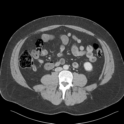 Adrenal cyst (Radiopaedia 45625-49777 Axial C+ portal venous phase 60).png