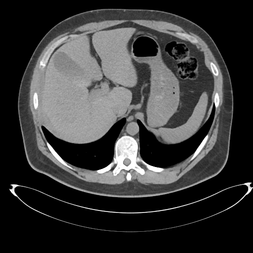 File:Adrenal cyst (Radiopaedia 45625-49778 Axial non-contrast 18).png