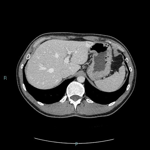 Adrenal cystic lymphangioma (Radiopaedia 83161-97534 Axial C+ portal venous phase 21).jpg