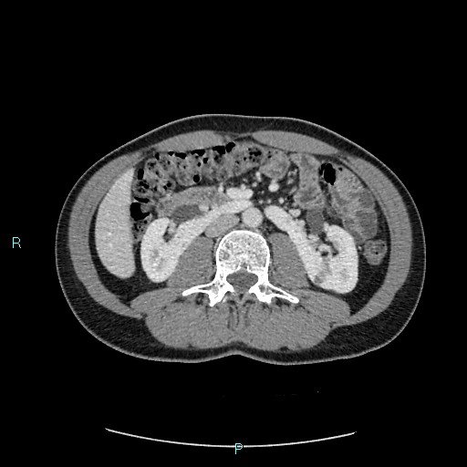 Adrenal cystic lymphangioma (Radiopaedia 83161-97534 Axial C+ portal venous phase 46).jpg