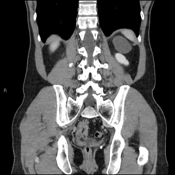 Adrenal cystic lymphangioma (Radiopaedia 83161-97534 Coronal C+ portal venous phase 57).jpg