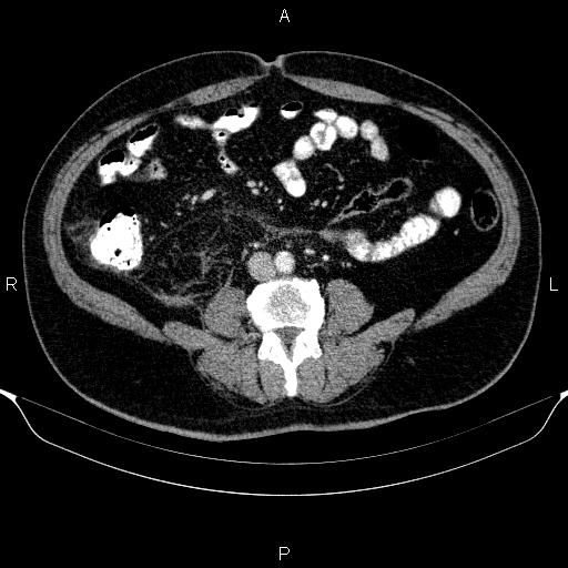 Adrenal hemorrhage (Radiopaedia 62622-70916 Axial C+ portal venous phase 114).jpg