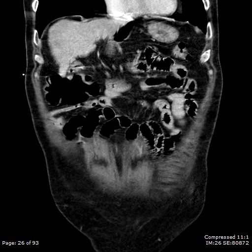 Adrenal metastasis (Radiopaedia 78425-91079 Sagittal C+ portal venous phase 13).jpg