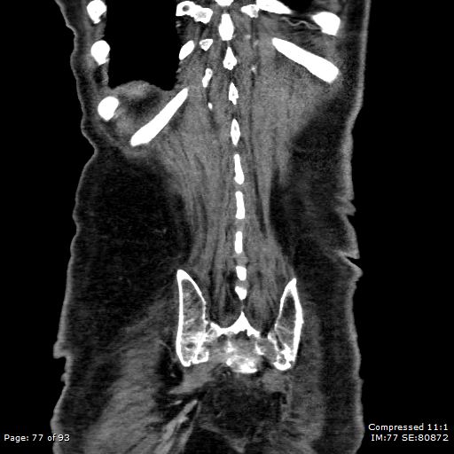 Adrenal metastasis (Radiopaedia 78425-91079 Sagittal C+ portal venous phase 64).jpg