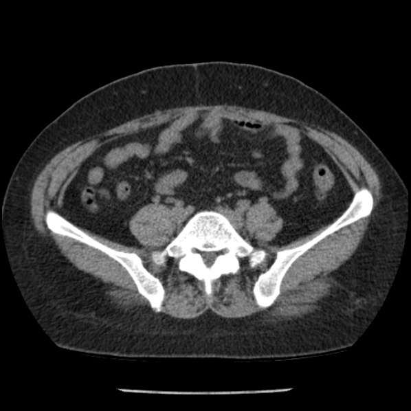 File:Adrenal myelolipoma (Radiopaedia 43401-46759 Axial non-contrast 60).jpg