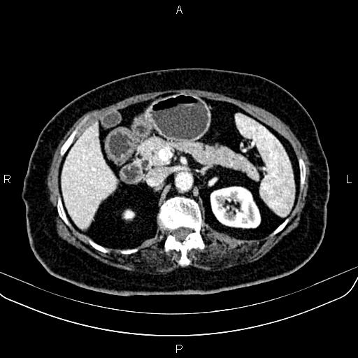 Adrenal myelolipoma (Radiopaedia 82742-96986 Axial renal cortical phase 61).jpg