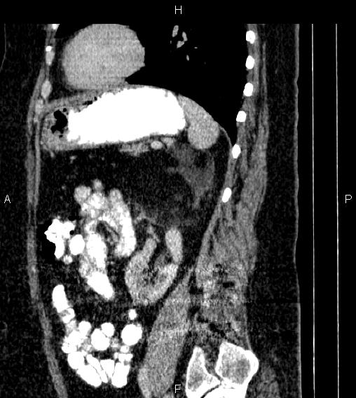 Adrenal myelolipoma (Radiopaedia 84319-99617 Sagittal renal cortical phase 66).jpg