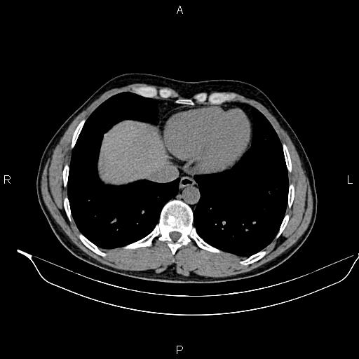 Adrenal myelolipoma (Radiopaedia 87794-104246 Axial non-contrast 12).jpg