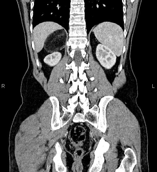 Adrenal myelolipoma (Radiopaedia 87794-104246 Coronal renal cortical phase 50).jpg