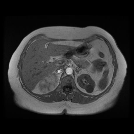 File:Adrenal myelolipoma - MRI (Radiopaedia 83249-97646 Axial T1-in phase 10).jpg