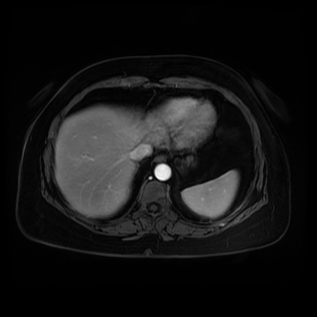 Adrenal myelolipoma - MRI (Radiopaedia 83249-97646 T1 fat sat arterial phase 6).jpg