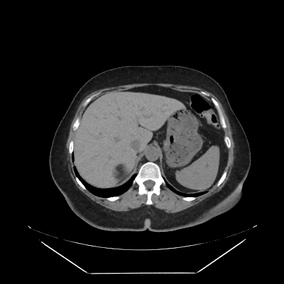 Adrenal myelolipoma - MRI (Radiopaedia 83249-97647 Axial non-contrast 3).jpg