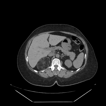Adrenal myelolipoma - MRI (Radiopaedia 83249-97647 Axial non-contrast 31).jpg