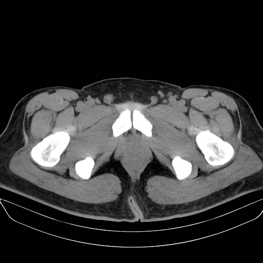 Adrenal myelolipoma - bilateral (Radiopaedia 74805-85810 Axial non-contrast 87).jpg