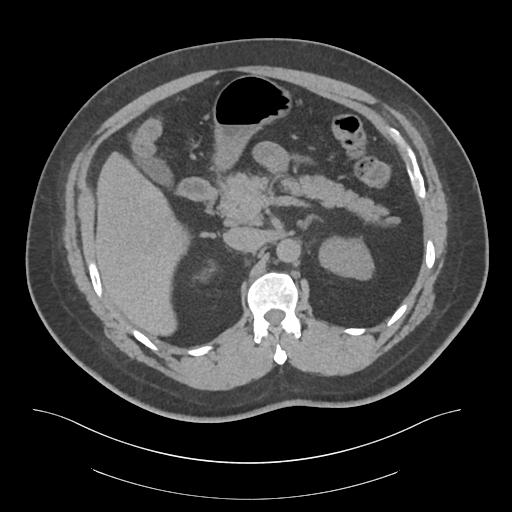File:Adrenal vein sampling and adrenal nodular hyperplasia - Conn syndrome (Radiopaedia 30561-31337 Axial non-contrast 27).jpg