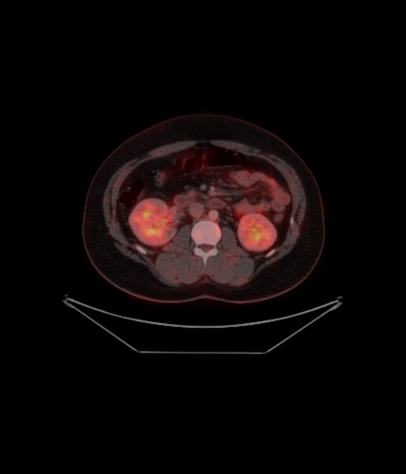 Adrenocortical carcinoma (Radiopaedia 80134-93440 ِAxial 182).jpg