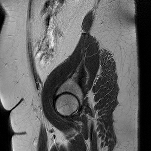 File:Adult granulosa cell tumor of the ovary (Radiopaedia 64991-73953 Sagittal T2 2).jpg