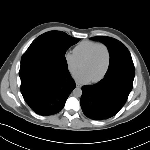 File:Adult polycystic kidney disease (Radiopaedia 47866-52626 Axial non-contrast 1).png